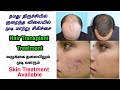   hair transplant treatment bonitaa skin  hair care trichy  coimbatore