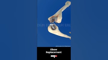 Total Elbow Replacement ↪ 3D Medical Animation #Shorts #ElbowReplacement #Elbow #Surgery