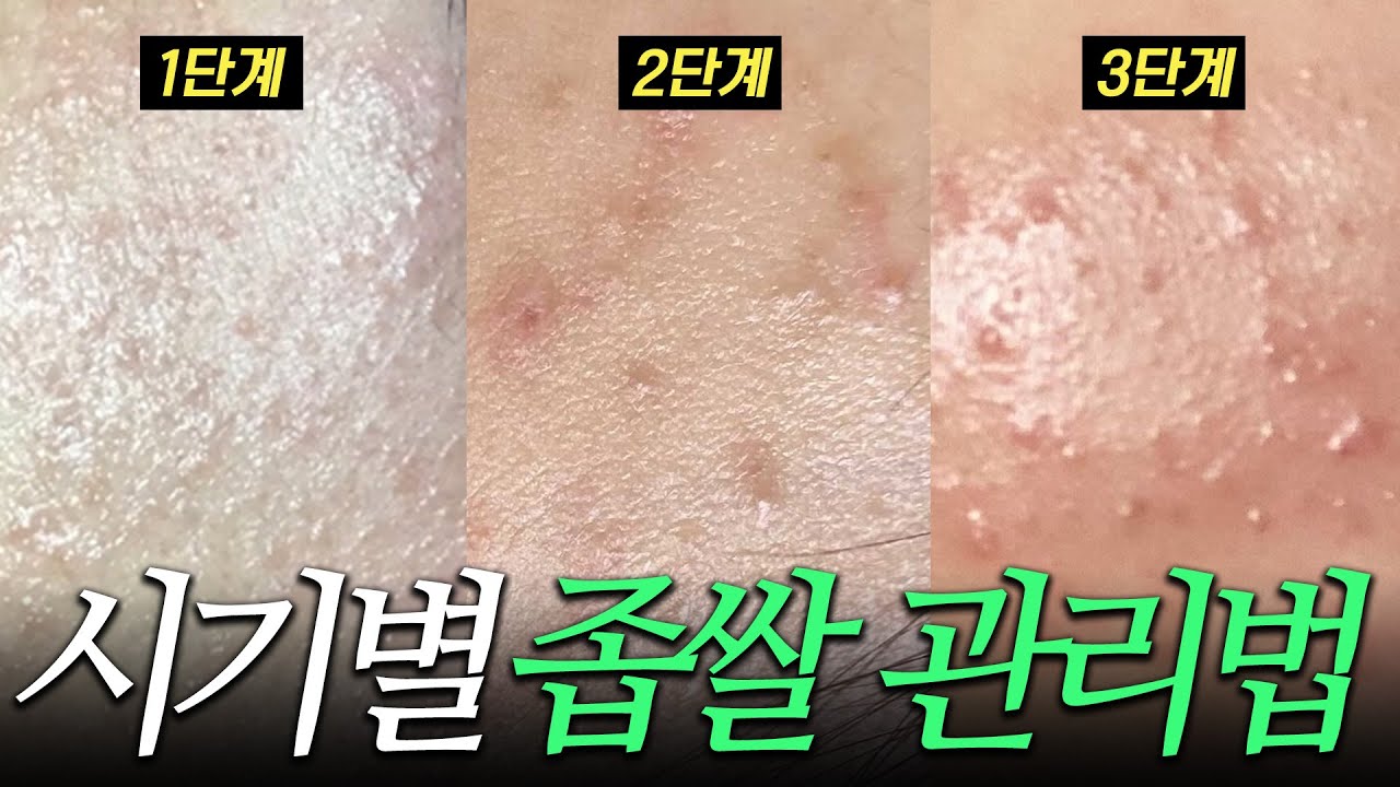 다 같은 좁쌀이 아닙니다 시기별 좁쌀 여드름 관리법 (+ 제품 추천까지) - YouTube