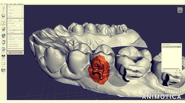 Debonding and removing orthodontic brackets in Meshmixer for Essix retainer