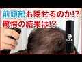 増毛スプレーでM字の生え際も隠せる！？前髪薄毛を隠せるか実際に増毛スプレーCAXカックスを使ってみた結果