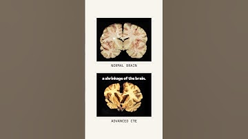 Concussions, explained