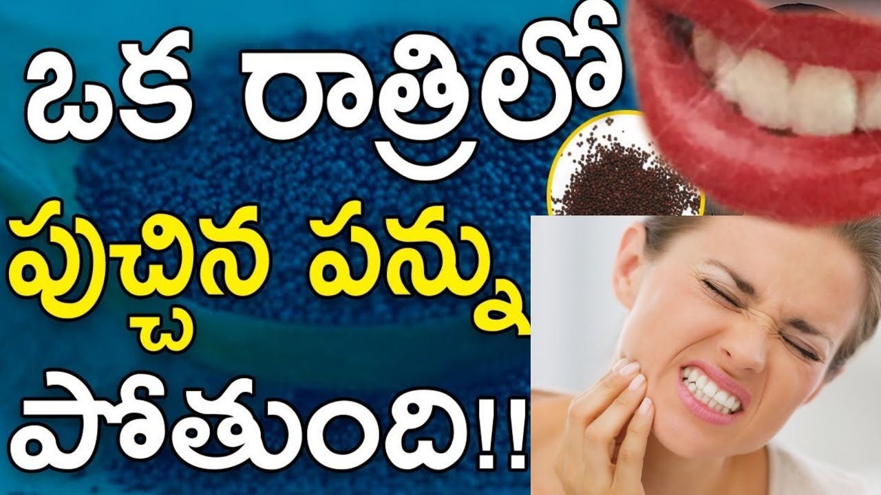 పంటినొప్పి 5 నిమిషాల్లో తగ్గాలంటే... Emergency Toothache Relief