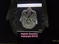 MR ANGIOGRAM NORMAL LIMIT.