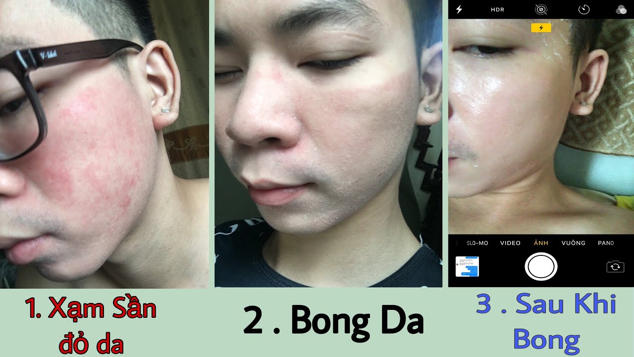 Đối tượng dùng trị mụn Bà Lão