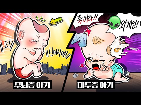 (영상툰) 충격실화! "무뇌증 아기"가 신으로 불린다고? 그런데 난 왜...⁉️ 무뇌증과 대두증 아기👶🔥[썰토리 영상툰]