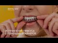 Исправление прикуса с помощью элайнеров в стоматологической клинике Dental Way