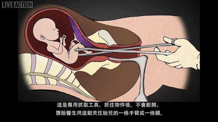 怀孕13至24周的手术堕胎法：扩张清宫术（繁体字幕） - 天天要闻