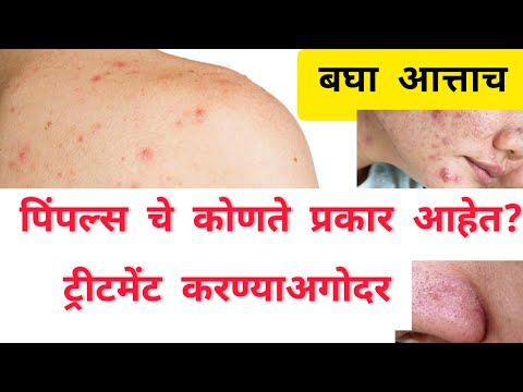 मुरुमांचे कोणते प्रकार आहेत? | Types Of Pimples | Healthy Tips Marathi