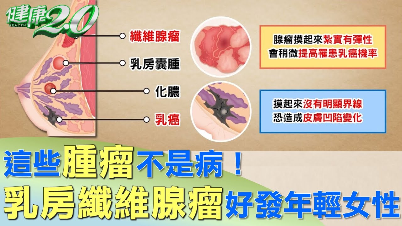 這些腫瘤不是病 乳房纖維腺瘤好發年輕女性健康2 0 Youtube
