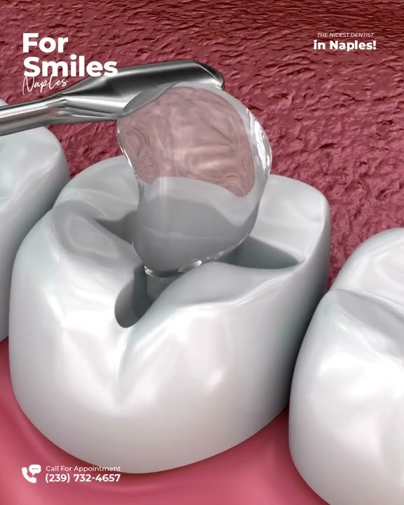 Restore Your Smile Naturally with Tooth-Colored Fillings | For Smiles Naples, FL
