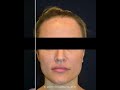 Dr. Champagne - Hairline Lowering Before & After