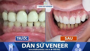 Dán Sứ Veneer - Lựa Chọn Hàng Đầu Mang Lại Nụ Cười Đẹp Dưới Mọi Góc Nhìn - Nha Khoa Quốc Tế Việt Đức