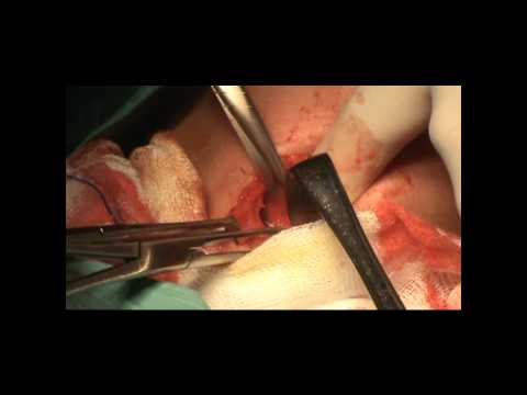 Thyroglossal Cyst excision.wmv