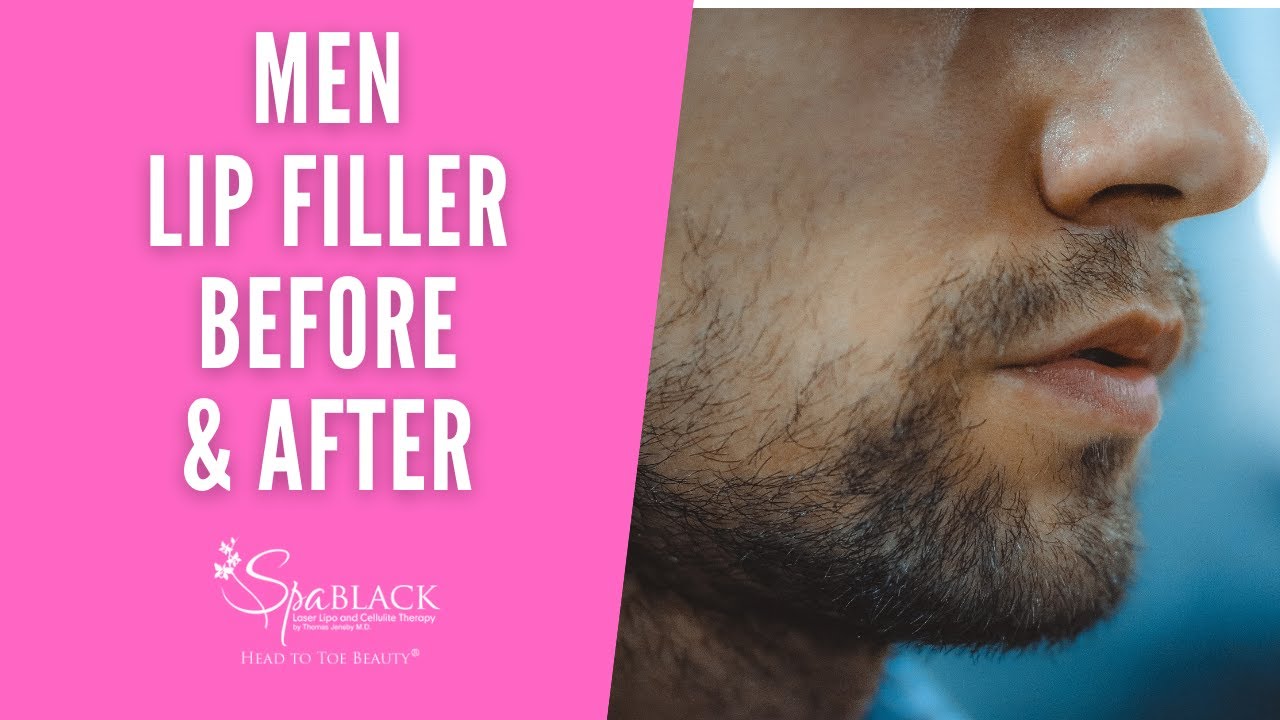 Lip Filler Before and After San Antonio Spa Black Lip Fillers shorts