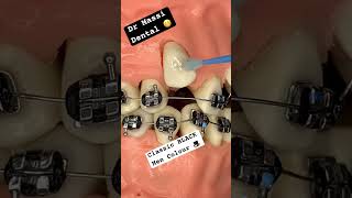 CLASSIC BLACK BRACES for Boys, Orthodontics