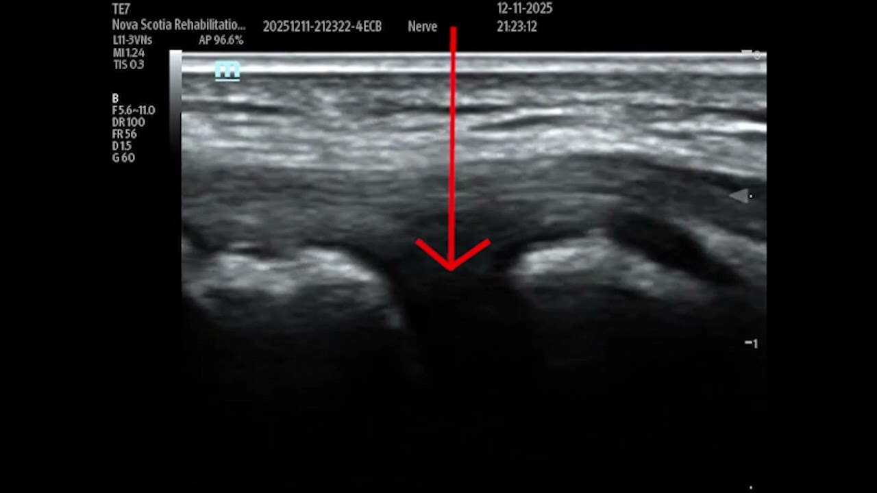 Ultrasound guided elbow joint injection