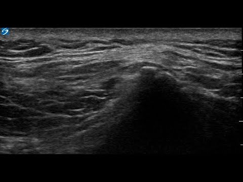 【Pain Hydrodissection series: Superior Cluneal Nerve "De-sandwiching"】