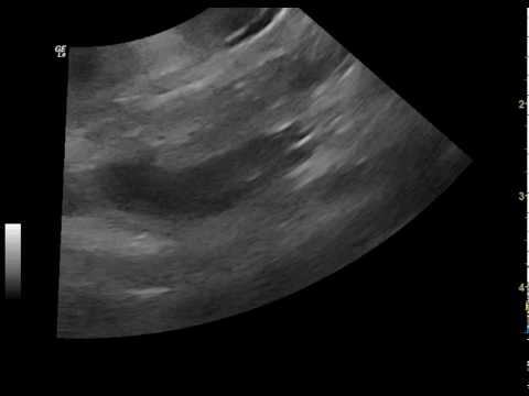 ultrasonography of the portal vein from a dog with gas bubbles entering from the mesenteric vein