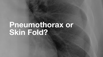 Pneumothorax vs. Skin Fold