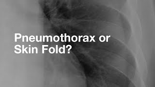 Pneumothorax vs. Skin Fold