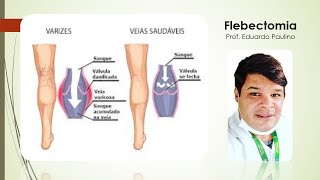 Flebectomia Professor Eduardo Paulino
