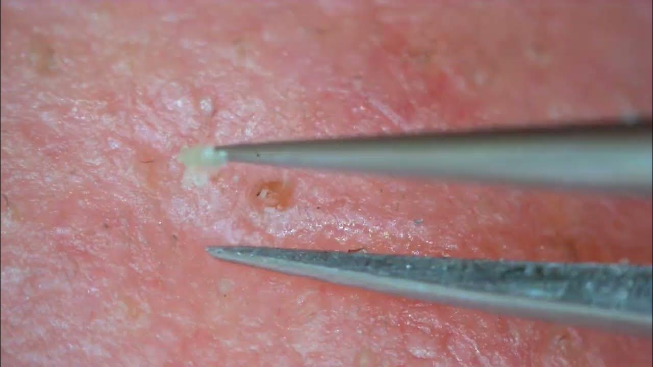 0191 keratin plug removal nose YouTube