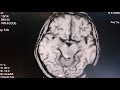 MRI|1mm cuts|pineal gland tumor (Brain)