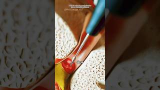 How Myringotomy Procedure Is Performed (3D Animation)