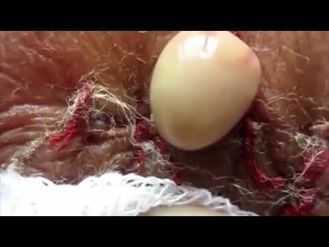 HUGE CYSTIC ACNE EXTRACTION #