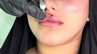    Lip Filler Injection Training: Step-by-Step Guide 2026