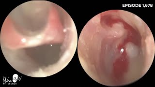 1,678 - 16 Year-Old With Possible Bilateral Cholesteatoma Right Ear