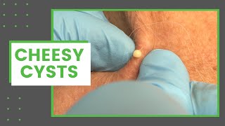 Cheesy Cysts | Dr. Derm