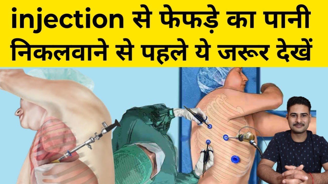 बिना injection फेफड़ों का पानी निकालें | fefdo me pani kyu bharta hai ...