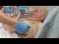 Manual Defibrillation with the HeartStart Intrepid monitor/defibrillator