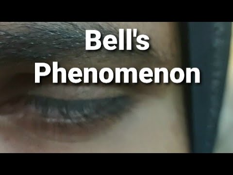 Bell's Phenomenon in Bell's Palsy - YouTube