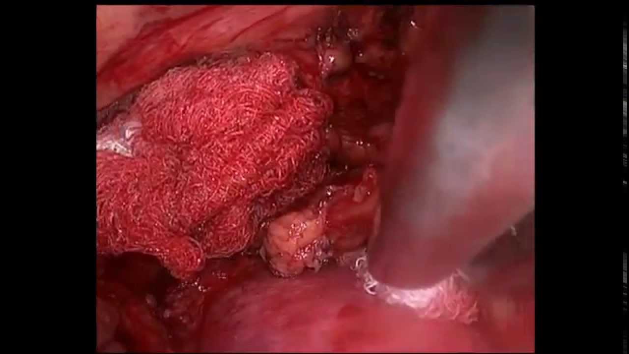 Кровотечение - удаление образования средостения.