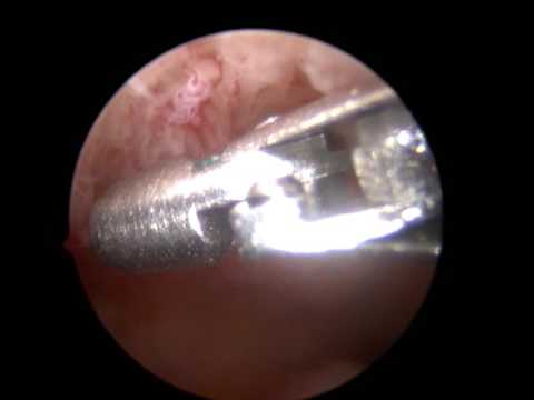 Video: Hysteroskopie Dělohy (odstranění Polypů): Příprava, Pooperační Období