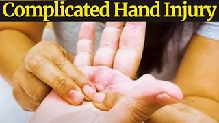 Tackling A Complicated Hand Injury & Finger Amputation & Fracture