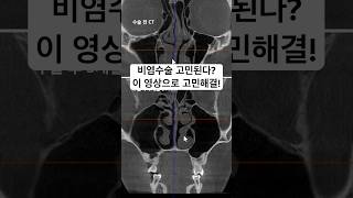 비염수술 고민된다? 이 영상 꼭 보세요! #비염 #비염치료 #코성형후기