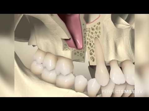 Video: Sind Zahnknochen? Woraus Zähne Und Knochen Bestehen