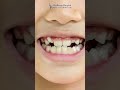 What to do if your teeth are misaligned? #chellaramhospital #shorts #dentailcare #dentistrytips