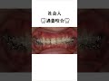 ディープバイト・過蓋咬合の歯列矯正治療 #dentist #矯正歯科 #歯医者
