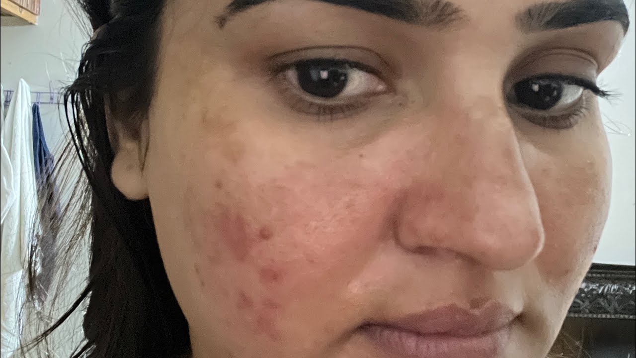 PM Skincare Routine | Niacinamide + Azelaic Acid for Clear & Even Skin 