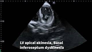 Akinesia,hypokinesia,dyskinesia,aneurysm