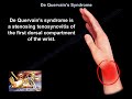 De Quervain's Syndrome - Everything You Need To Know - Dr. Nabil Ebraheim