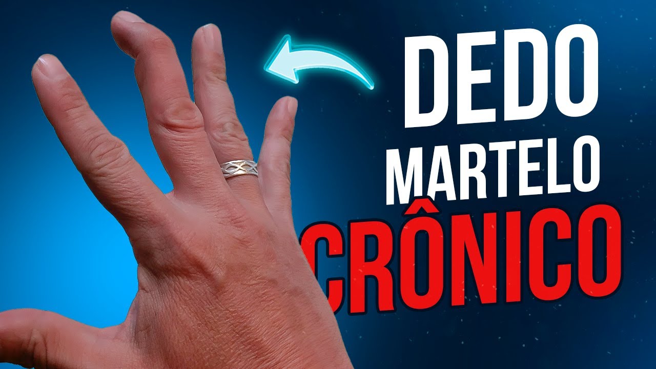 DEDO EM MARTELO CRÔNICO SAIBA COMO ACONTECE E QUAL O TRATAMENTO FIX IT YouTube DEDO EM MARTELO CRÔNICO SAIBA COMO ACONTECE E QUAL O TRATAMENTO FIX IT YouTube