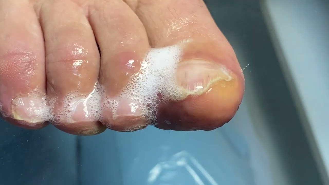 Обработка псориазных ногтей. #псориазмосква #псориаз #псориазногтей #подологмосква #псориазлечение