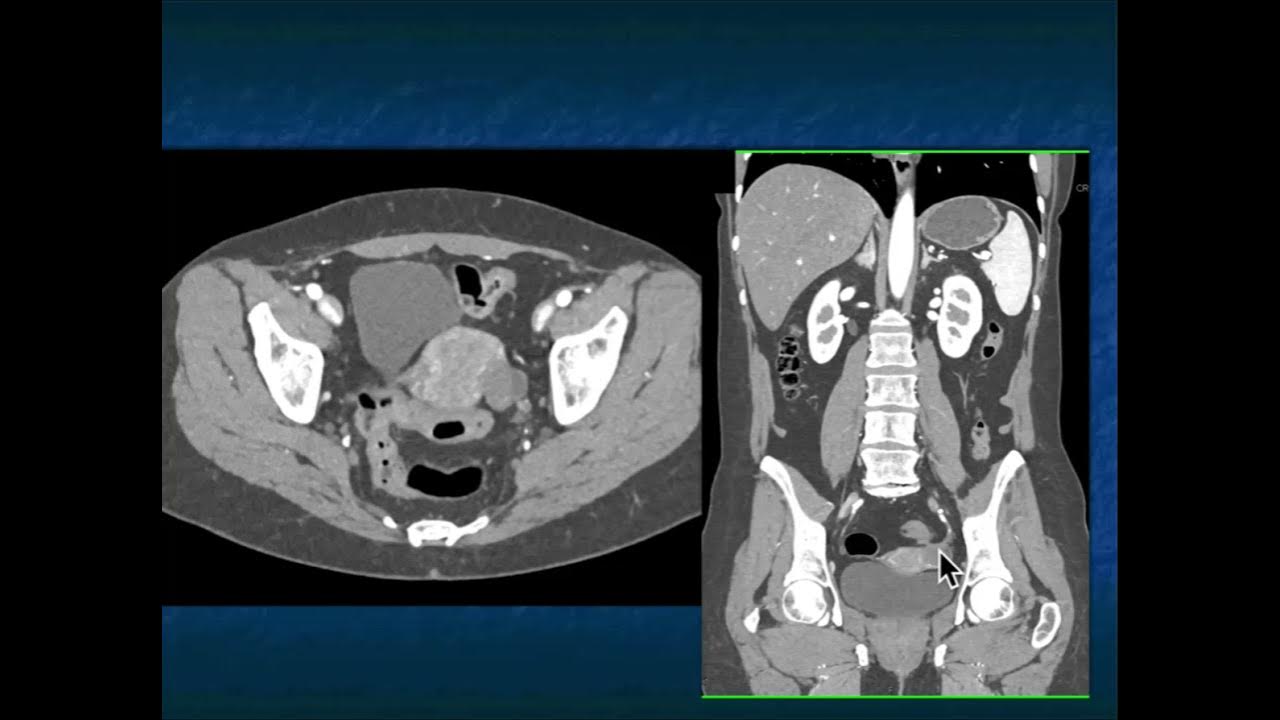 CT Evaluation of Endometriosis YouTube