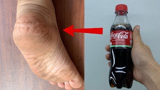 Get Rid of CRACKED HEELS Permanently, Magical Cracked Heels Home Remedy screenshot 1